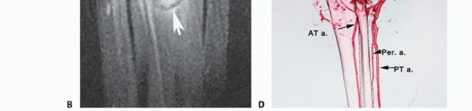 Illustration 4 for Soleus Resection for Tumors: Protecting the Heads of the Gastrocnemius