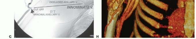 Illustration 19 for Limb-Sparing Resections Around the Shoulder: Optimizing Outcomes