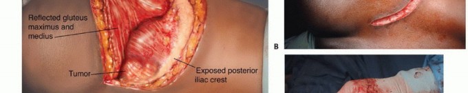 Illustration 26 for Pelvic Metastasis Surgery: A Component of the Utilitarian Approach
