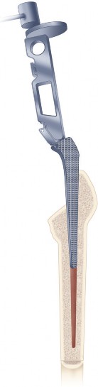 Illustration 10 for Cemented Femoral Stem Figures: Surgical Anatomy & Placement