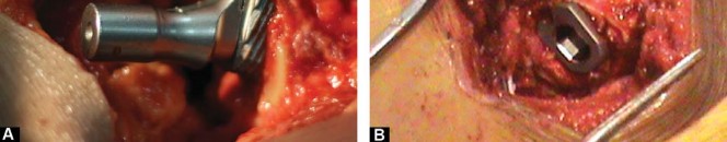 Illustration 10 for Considering METHA Short Stem? Discover Bone-Preserving THA