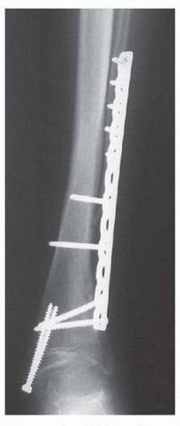 Illustration 15 for Distal Tibial Osteotomy: Fixing Varus & Valgus Ankle Alignment
