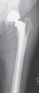 Illustration 12 for Advanced Arthroplasty for Malignant Lesions: Reclaim Your Mobility