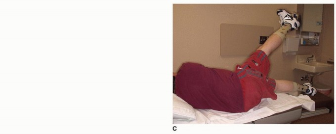 Illustration 27 for Allograft Prosthetic Composite: Mastering Proximal Femur Reconstruction