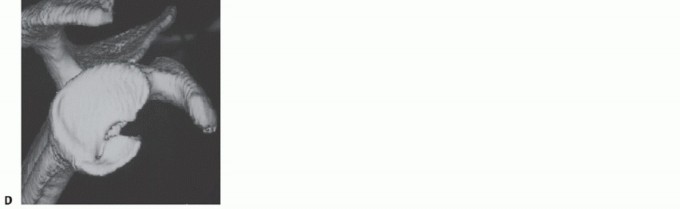 Illustration 5 for Bankart Repair & Inferior Capsular Shift: Solving Shoulder Instability