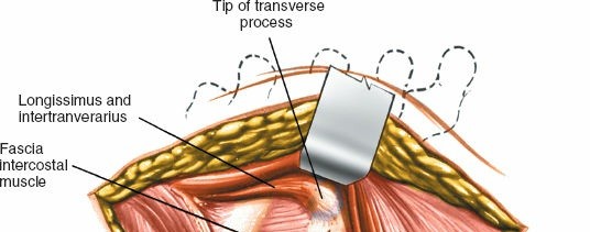 Illustration 294 for Approach to the Lumbar Spine: Mastering Techniques & Anatomy