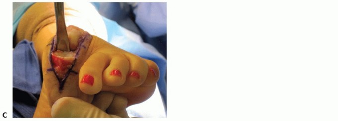 Illustration 43 for End Articular Cartilage Loss: Arthrosurface HemiCAP Resurfacing