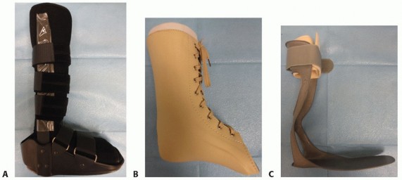 Illustration 4 for Lateral Column Lengthening: Relieve Flatfoot Pain & Correct Deformity
