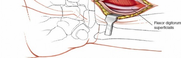Illustration 7 for Volar Approach: Optimal Exposure for the Volar aspect of the Distal Radius