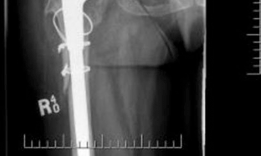 Illustration 8 for Solving Severe Acetabular Bone Loss with Cup-Cage Reconstruction