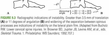 Illustration of cervical spine fracture - Dr. Mohammed Hutaif