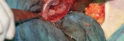 Illustration 59 for Collum Femoris Preserving: Achieve Better Primary Hip Outcomes