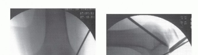 Illustration 37 for Dissecans of the Knee: What's the Difference – OCD vs. AVN?