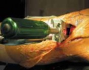 Illustration 34 for Guide Pin Assembly: Key to Flawless Upper Tibial Osteotomy