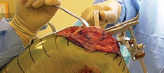 Illustration 20 for Optimize Tibial Component Alignment: Techniques for TKA Success