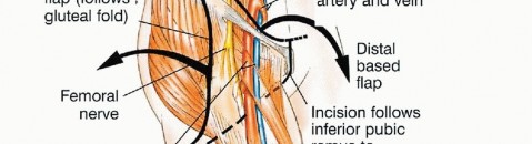 Illustration 35 for Surgical Pelvic Resection: Gluteus Maximus Muscle & Nerve Preservation