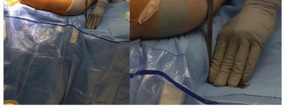 Illustration 5 for Extensively Porouscoated Stems: Proven Success & Superior Fixation