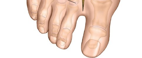 Illustration 206 for Optimized Approaches to the Dorsum of the Foot & Ankle