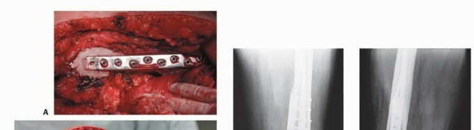 Illustration 45 for Mastering Femoral Metastases: Optimal Function for Femoris & Vastus