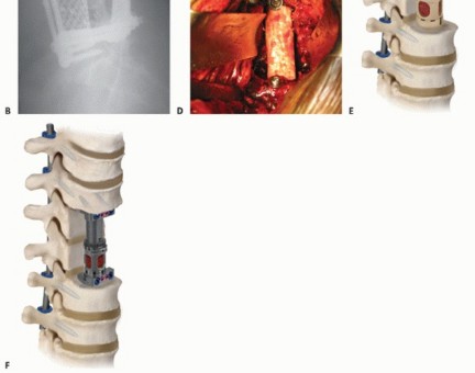 Illustration 22 for Anterior Lumbar Interbody: Fusion, Disc Replacement & Pain Relief