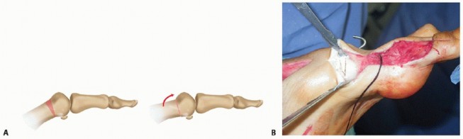 Illustration 43 for How Achilles Tendon Lengthening Fixes Equinocavovarus Foot