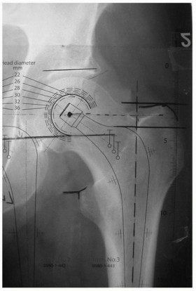 Illustration 2 for Why Polished Tapered Cemented Stems Excel in Hip Replacement