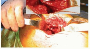 Illustration 6 for Why Double-Tapered Primary Stems Deliver Lasting Stability