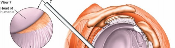 Illustration 239 for Essential Guide: Mastering Every Approach to the Shoulder