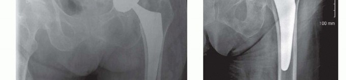 Illustration 18 for Total Hip Arthroplasty: Journey to Preventing Complications
