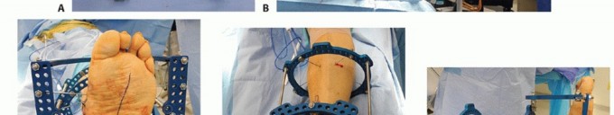 Illustration 26 for Regain Mobility: Surgical Solutions for Charcot Foot Arthropathy