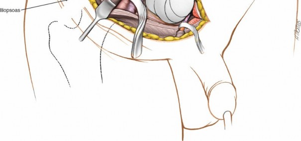 Illustration 75 for Pelvis & Acetabulum Approaches: Unlocking the Posterior Superior Iliac