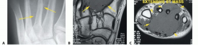 Illustration 5 for Treating Tumors of the Foot: Optimizing Amputation & Resection