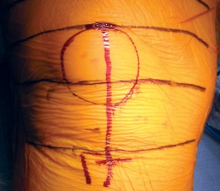 Illustration 4 for Minimally Invasive Subvastus: The Best Path to Quicker TKA Recovery