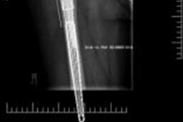 Illustration 6 for Solving Severe Acetabular Bone Loss with Cup-Cage Reconstruction