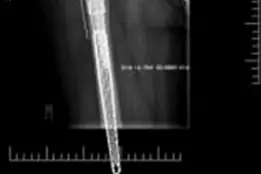 صورة توضيحية لـ إعادة بناء الحق بالقفص والكأس: حل متقدم لفقدان عظم الحوض الشديد