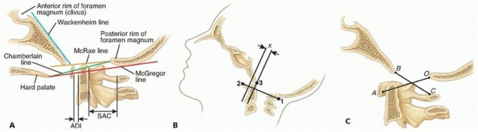 Illustration 3 for Addressing Cervical Spine Instability with Posterior Arthrodesis