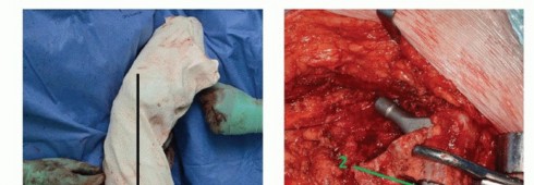 Illustration 38 for Special THA Techniques for Severe Deformities Around the Hip