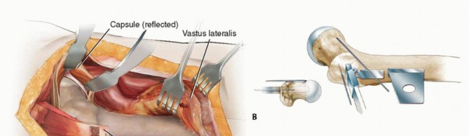 Illustration 11 for Proximal Femoral Osteotomy: When This Hip-Saving Surgery Is Performed