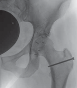 Illustration 33 for FAI: Impingement and Surgical Dislocation Explained