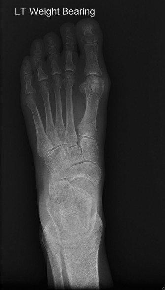 Illustration 2 for Foot Nodule Pain? Solutions for Masses along the Medial Cord