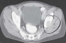 Illustration 5 for Advanced Arthroplasty for Malignant Lesions: Reclaim Your Mobility