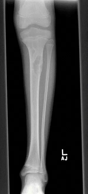 الورم الليفي غير المتعظم: دليل شامل للمرضى مع الأستاذ الدكتور محمد هطيف