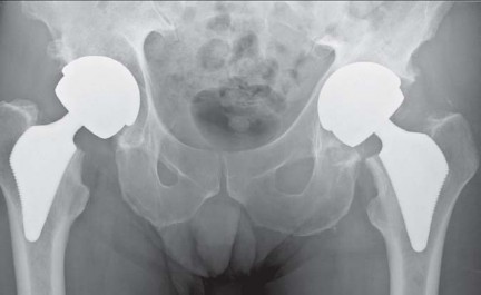 Illustration 28 for The Proxima: Why This Proximally Loading Implant Preserves Bone