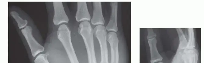 صورة توضيحية لـ كسور وخلوع مفاصل قاعدة الأصابع: دليل المريض الشامل للتعافي الكامل