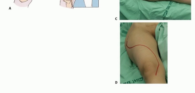 Illustration 18 for Beyond Amputation: Total Femur Resection with Endoprosthetics