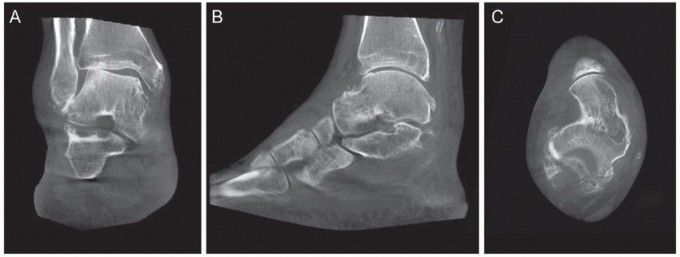 Illustration 7 for Medial Ankle Instability: Find Relief with Reconstruction