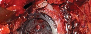 Illustration 55 for Management of Periprosthetic Fractures: An Expert Surgical Guide