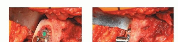 صورة طبية: استبدال مفصل الورك بدون أسمنت: استعادة الحركة والثبات في صنعاء مع الأستاذ الدكتور محمد هطيف