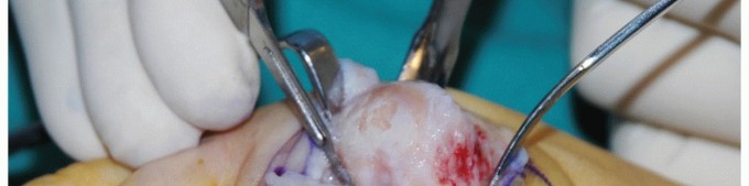 Illustration 14 for MTP Joint Arthrodesis: The Key to Optimal Toe Positioning