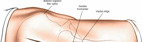 Illustration 101 for Unlocking Every Aspect of the Hip's Surgical Approaches